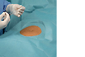 Hartmann Foliodrape® Protect Minor Surgery Set, 278003. Комплект для малой хирургии. 12 шт.